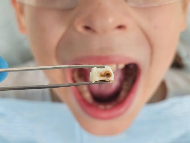 Best Emergency Tooth Extraction in Maryvle, IL